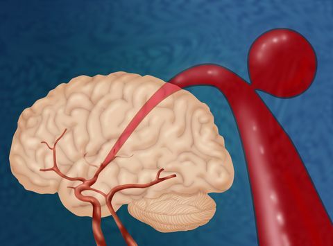 تمدد الأوعية الدموية في المخ